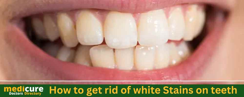 How to get rid of white Stains on teeth 