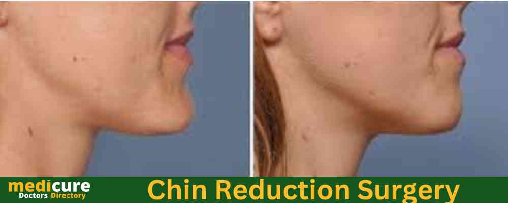 Chin reduction surgery Chin surgery