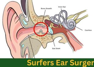 Surfers Ear Surgery – Cost and Recovery time