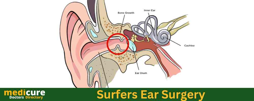 Surfers ear surgery