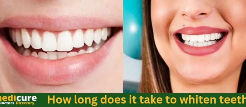 How long does it take to whiten teeth
