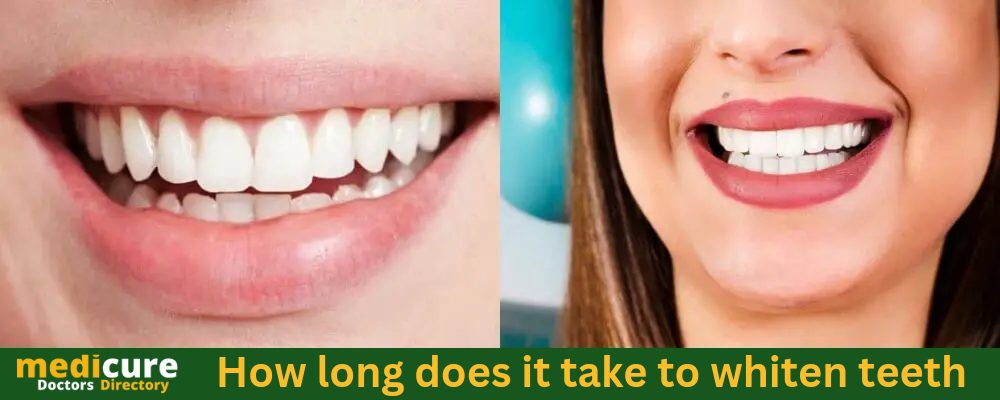 How long does it take to whiten teeth
