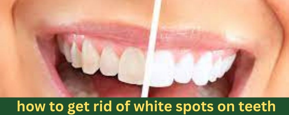 how to get rid of white spots on teeth