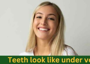 What do teeth look like under veneers ?