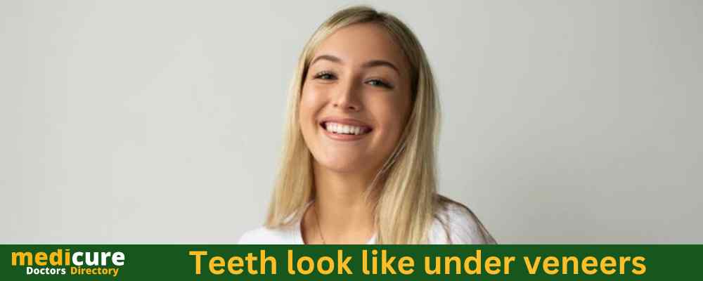 what do teeth look like under veneers?