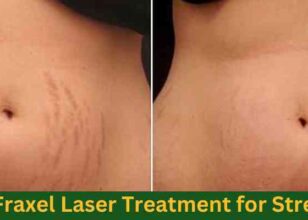 Fraxel Laser Treatment for Stretch Marks