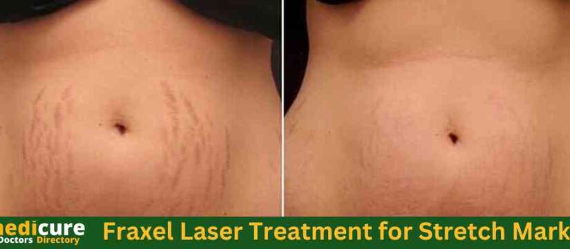 Fraxel Laser Treatment for Stretch Marks