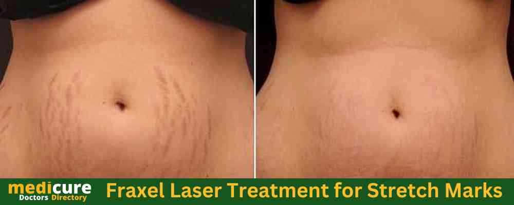 Fraxel Laser Treatment for Stretch Marks
Fraxel Laser Treatment Stretch Marks
