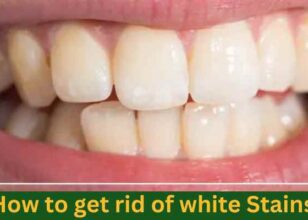 How to get rid of white stains on teeth