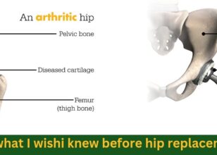 What I wish I knew before hip replacement surgery