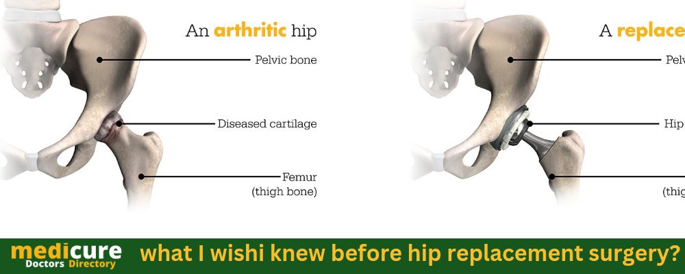 what I wish i knew before hip replacement surgery