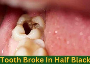 Tooth Broke In Half Black Inside: Causes, Treatment