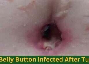 Belly Button Infected After Tummy Tuck: Causes, & Treatments