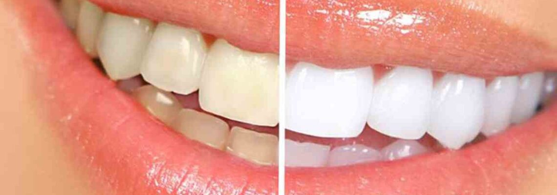 How to Whiten Teeth at Home in One Day ?