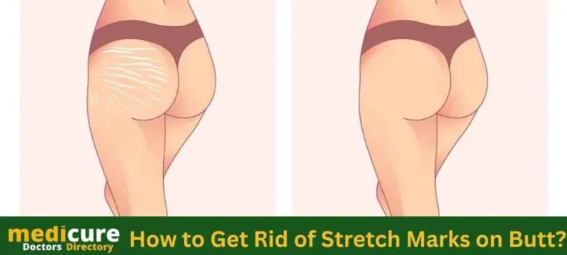 How to Get Rid of Stretch Marks on Butt?