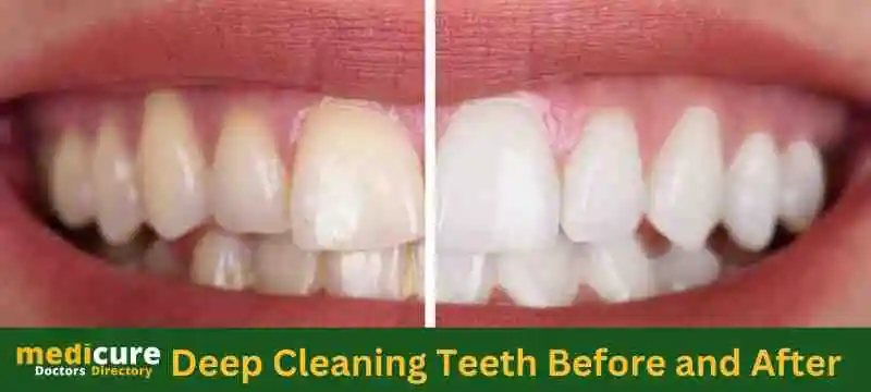 Deep Cleaning vs. Normal Cleaning for Teeth - Eagle Dental