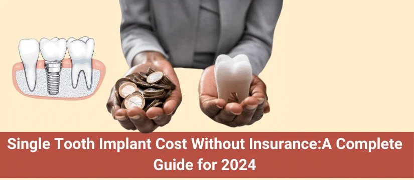 Single Tooth Implant Cost without Insurance