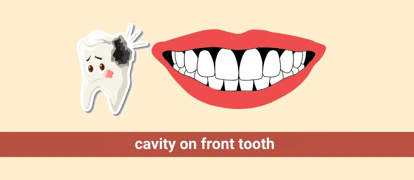 cavity on front tooth